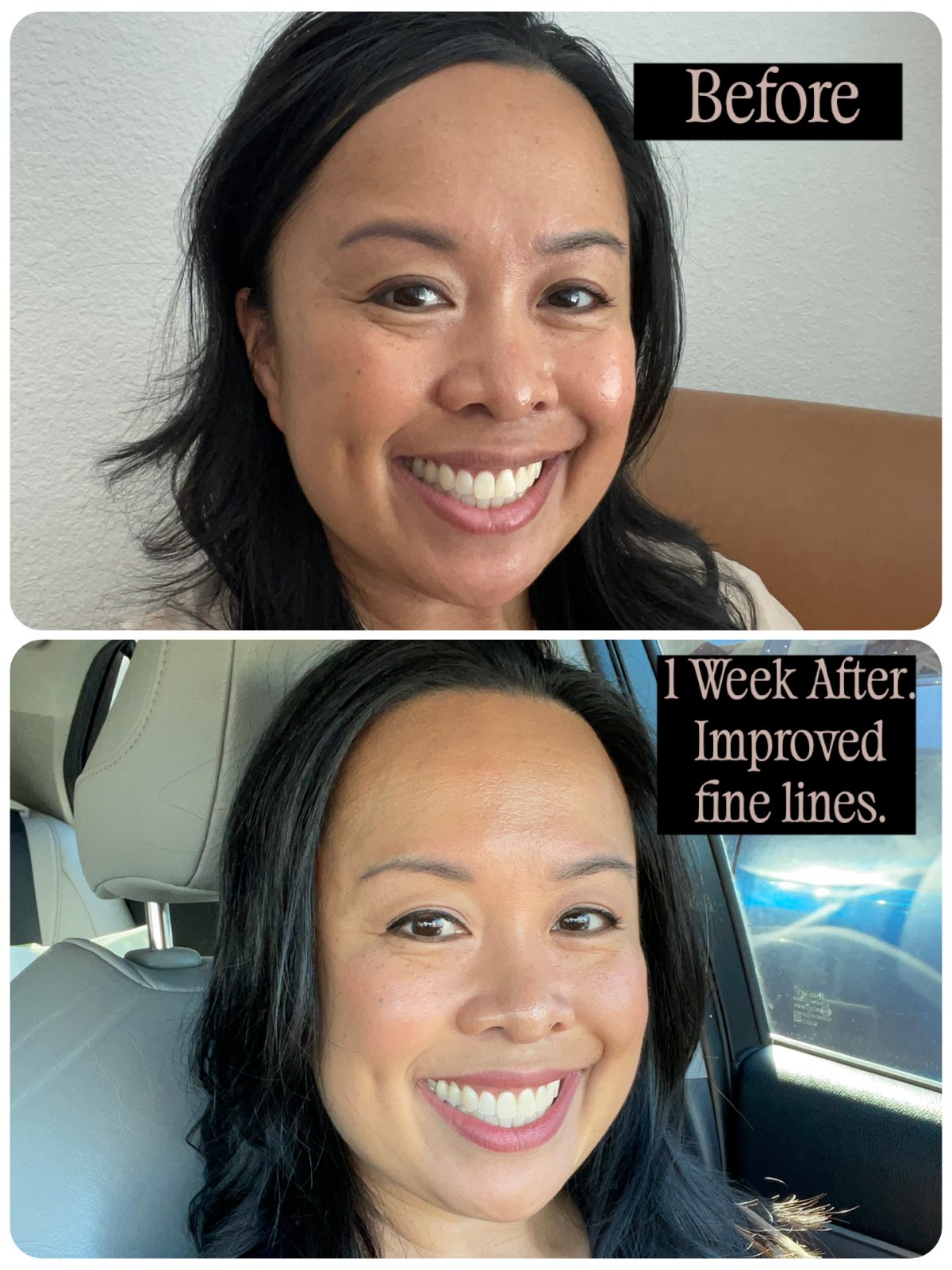 Before and after, softer fine lines after one week