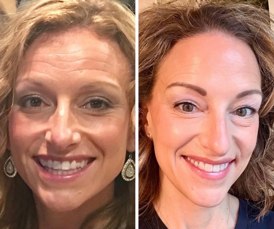 Before and after, smoother-looking fine lines