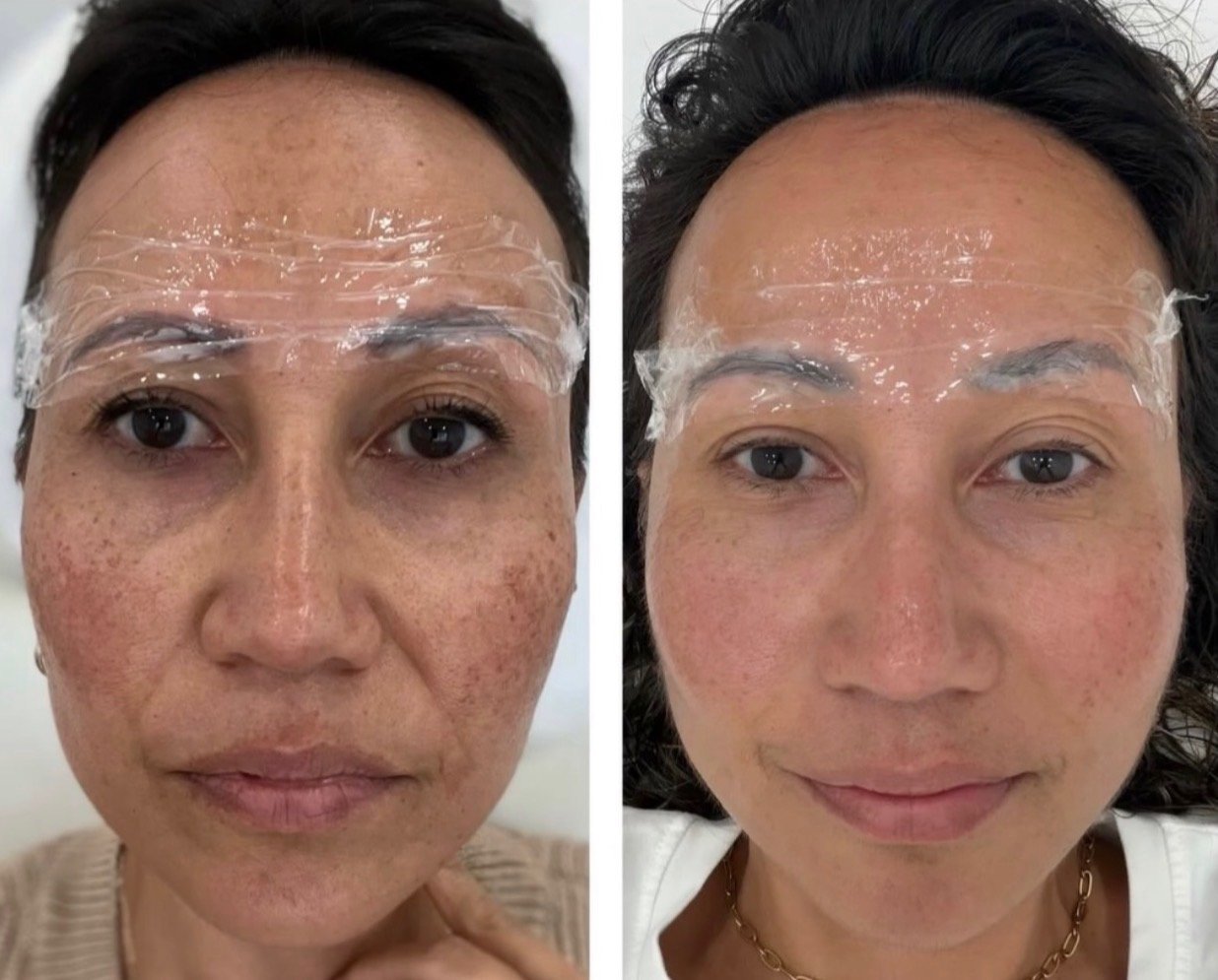 Before and after, more even-looking skin tone