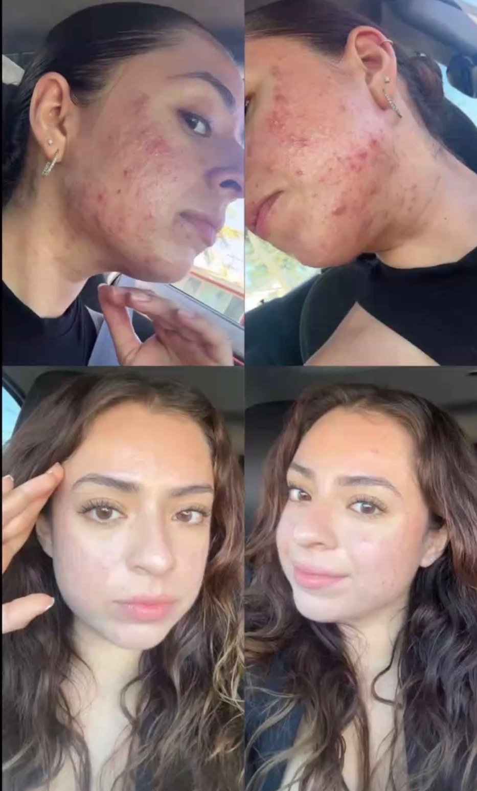 Before and after, clearer and smoother-looking skin