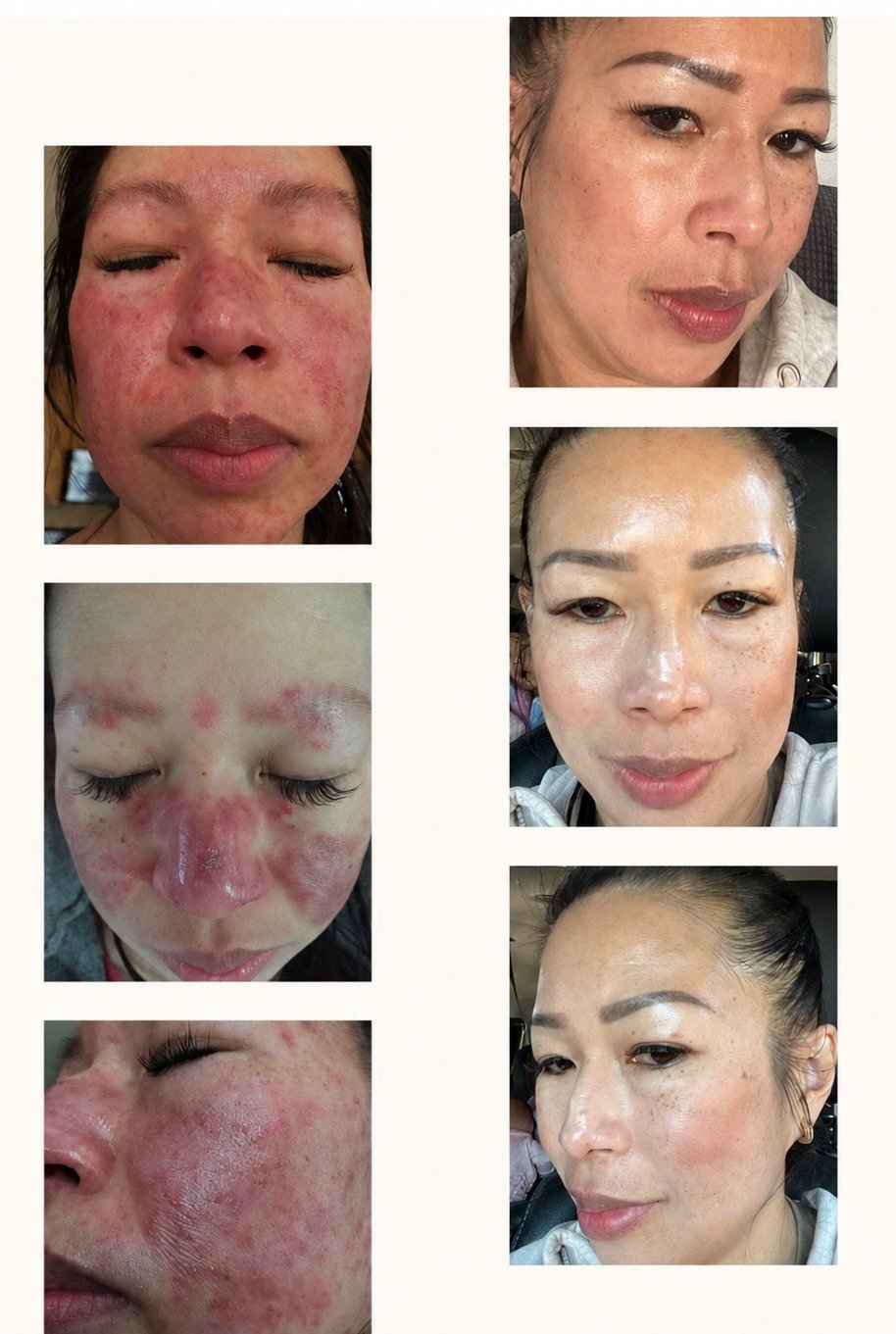 Before and after, calmer, clearer-looking skin